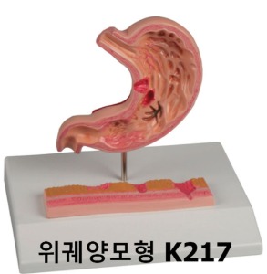 [독일Zimmer] 위궤양모형 K217 위염모형 출형성위염 위축성위염 위모형 Stomach with Ulcers/YS