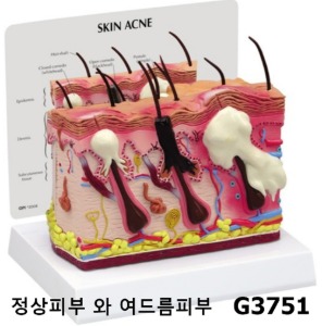 [GPI] 정상피부 와 여드름피부 비교모형 G3751