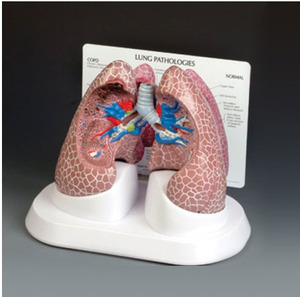 [GPI] 폐질환모형 G311 (Diseased Lung 311) 폐모형 허파모형