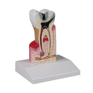 [독일Zimmer] 충치 모형 (실물 10배크기) D214 치아모형 Dental caries model, 10 times life size/YS
