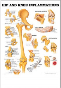 3D해부도(벽걸이)/9781/고관절 및 슬관절염증,무릎질환차트/Hip and Knee Inflammations/ Size 54cmx74cm