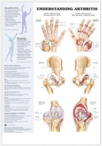 3D해부도(벽걸이)/9803/관절염차트,관절염의 이해/Understanding Arthritis)/ Size 54cmx74cm
