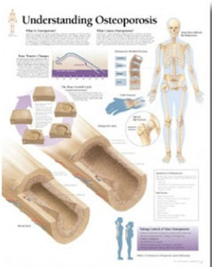 평면해부도(벽걸이)/1153/골다공증 차트/Understanding Osteoporosis/ Size 54cmⅹ74cm