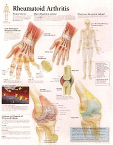 평면해부도(벽걸이)/1152/류마티스 관절염 차트/Rheumatoid Arthritis/ Size 54cmⅹ74cm
