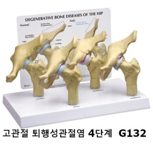 [GPI] 고관절 퇴행성관절염 4단계 모형 G132 (88x127xH101mm)