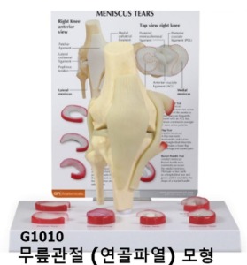 [GPI] 무릎관절모형 (반월상연골파열) G1010 실제사이즈