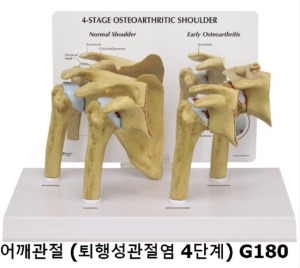 [GPI] 퇴행성 4단계 어깨관절모형 G180