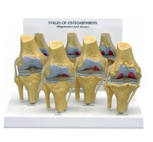 [GPI] 4단계 관절염모형 G110 (4-Stage Osteoarthritis Knee 110)