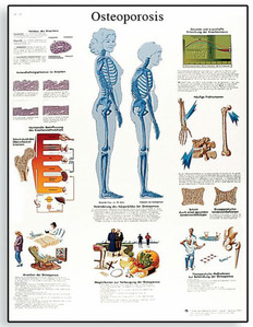 [3B] 골다공증 차트 VR1121L(코팅),VR1121UU(비코팅) Osteoporosis Chart (Size 50 x 67 cm)