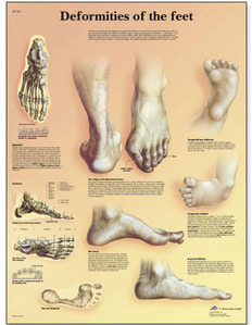[3B] 발의기형,기형발차트/VR1185L(코팅),VR1185UU(비코팅)/Deformities of the Feet Chart / Size 50x67cm