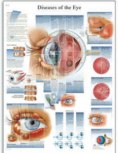 [3B] 안구질환차트,눈차트 VR1231L(코팅),VR1231UU(비코팅) Diseases of the Eye Chart  (Size 50cmⅹ67cm)