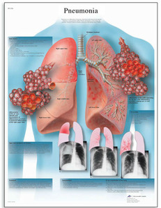 [3B] 폐렴차트(감염된폐방사선사진)/VR1326UU(비코팅)/Pneumonia Chart/ Size 50x67cm