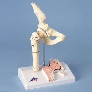[3B] 대퇴부모형 A88 (Femoral Fracture) 대퇴부골절 및 골관절염모형