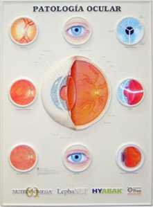 3D해부도(벽걸이)/9695RL/안과차트(수정체)/Disorders of  the Eye(Lenticular)/ Size 54cmx74cm