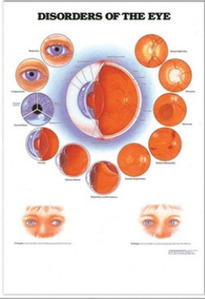 3D해부도(벽걸이)/9695/안과차트/Disorders of the Eye/ Size 54cmx74cm